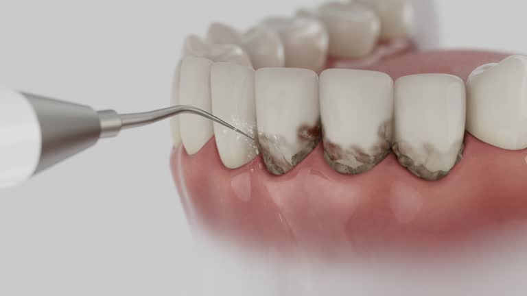 Trusted Dental Implants service in Buckeye Lake, OH - Dentist Open Now